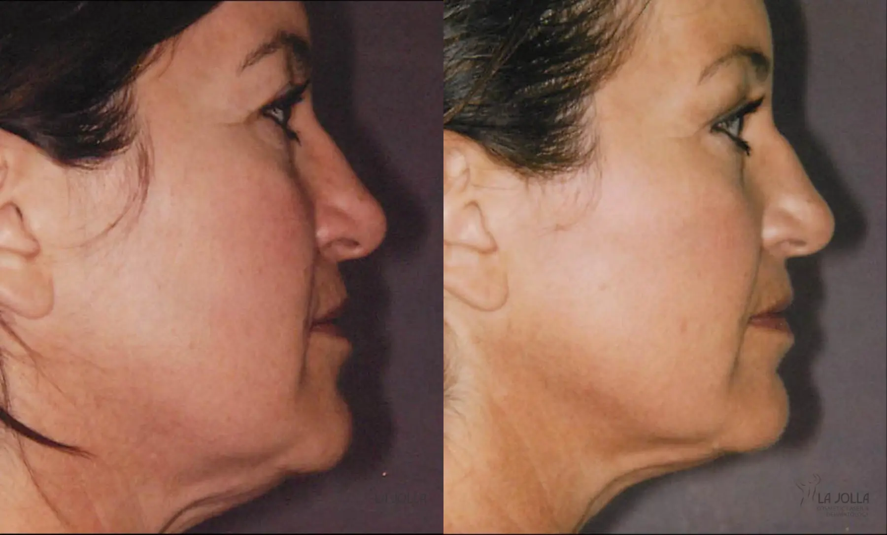 Thermage: Patient 6 - Before and After  