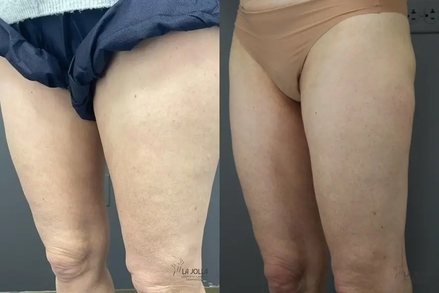 Thermage: Patient 4 - Before and After 2