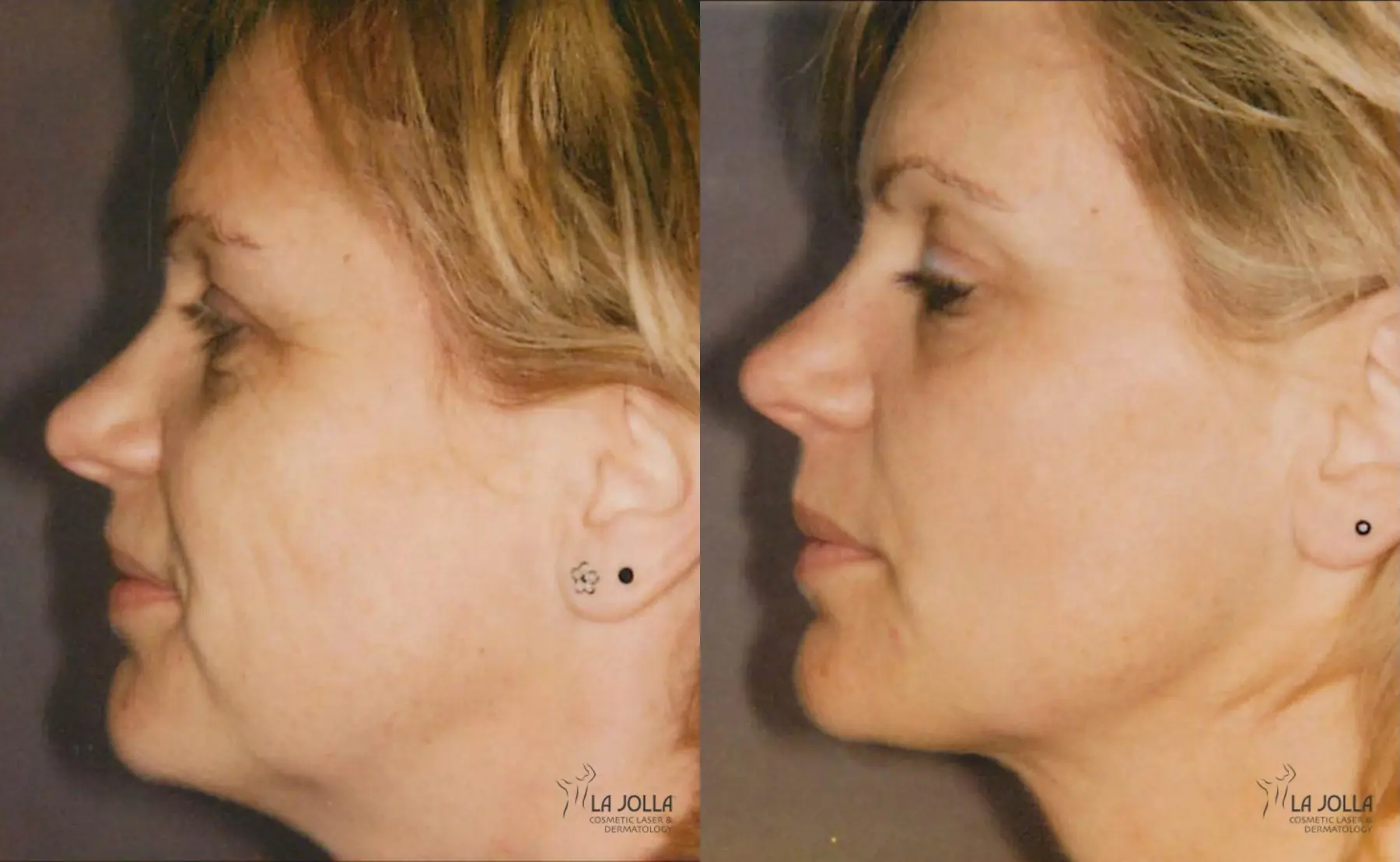 Thermage: Patient 2 - Before and After  