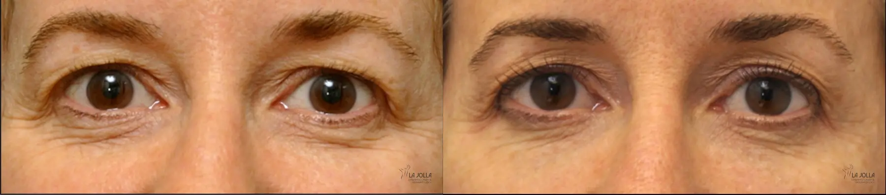 Thermage: Patient 3 - Before and After  