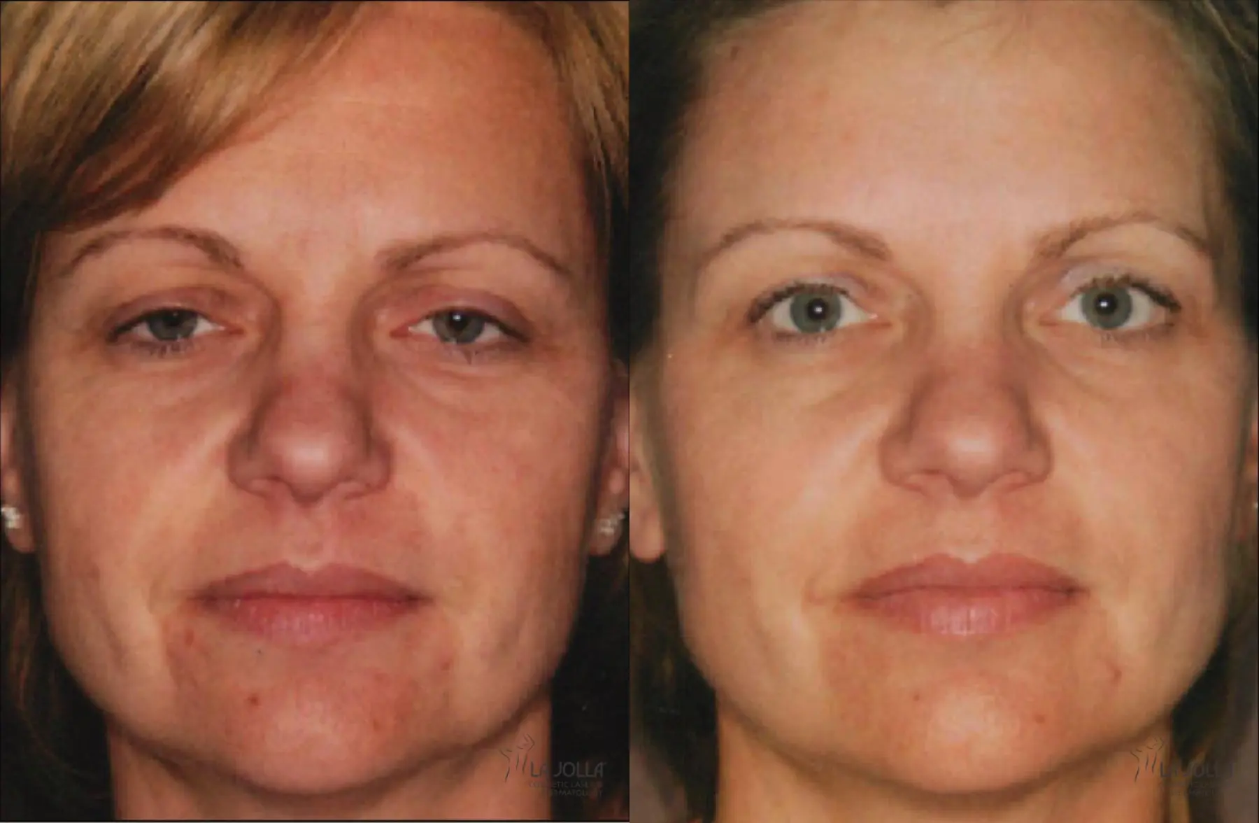 Thermage: Patient 1 - Before and After  