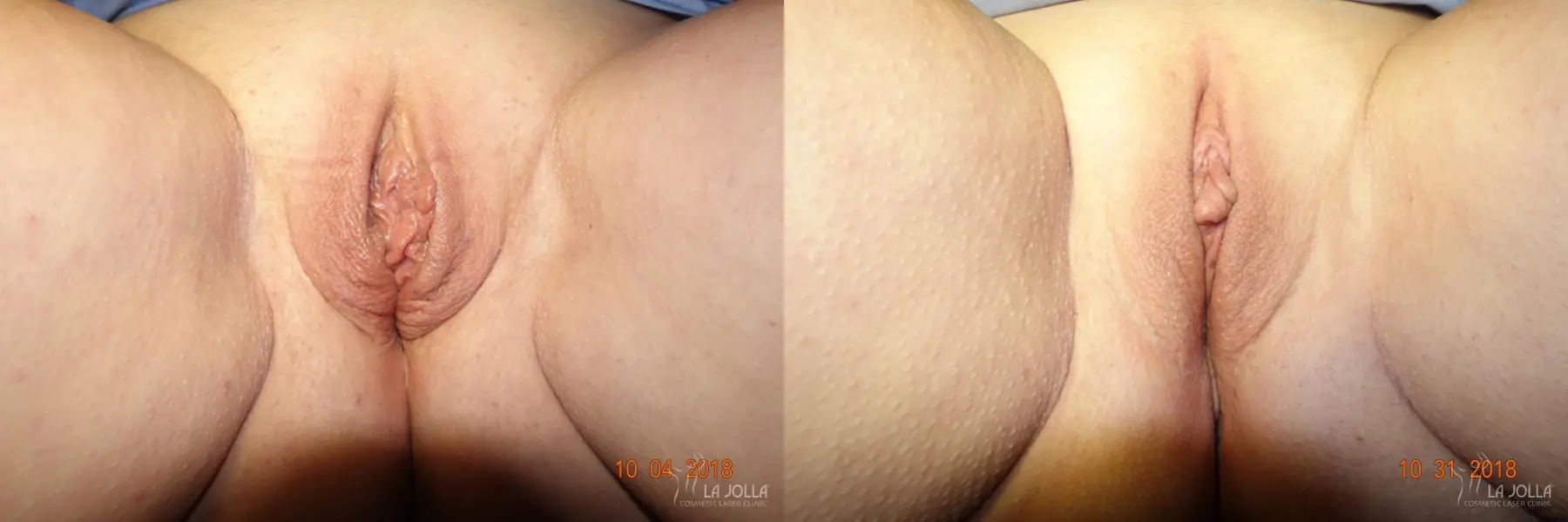 ThermiVa®: Patient 1 - Before and After 1