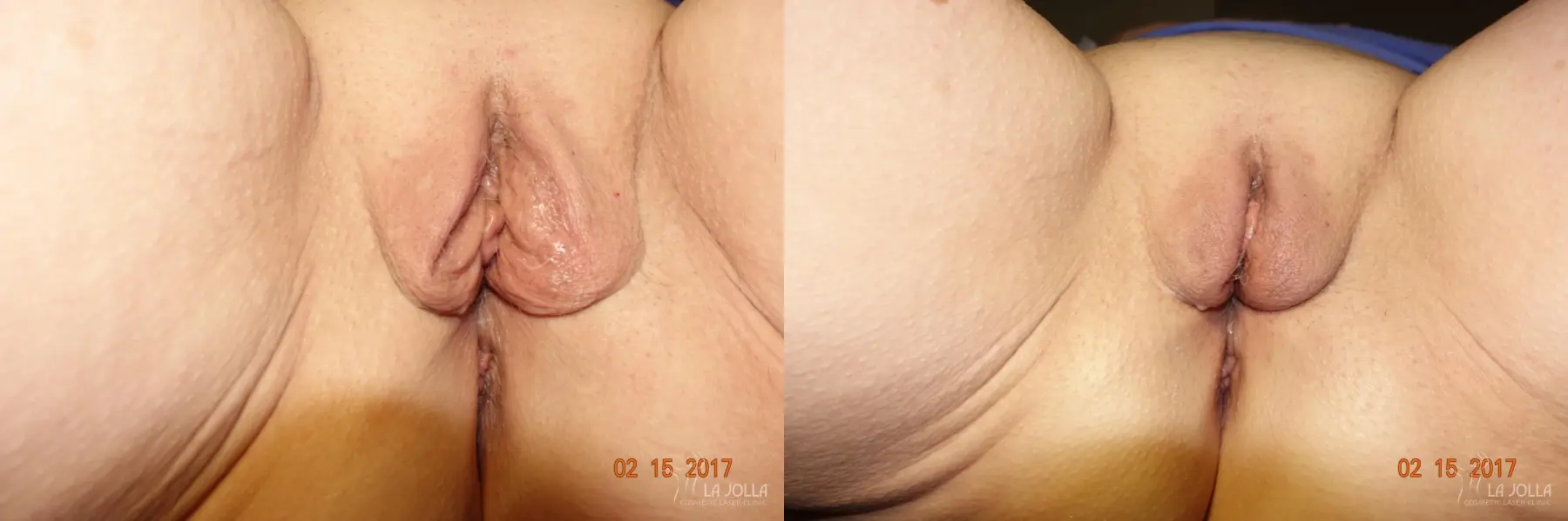 ThermiVa®: Patient 6 - Before and After 1