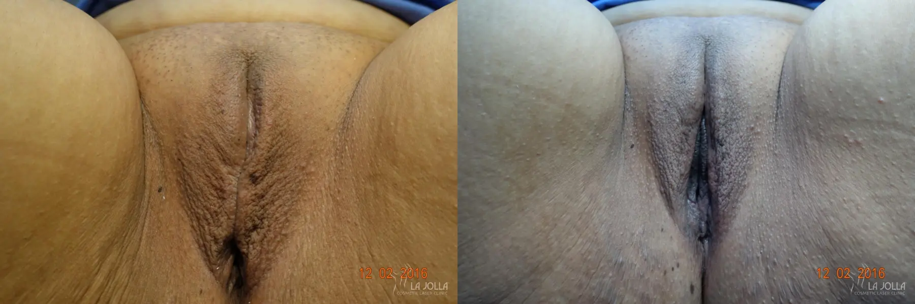 ThermiVa®: Patient 4 - Before and After  