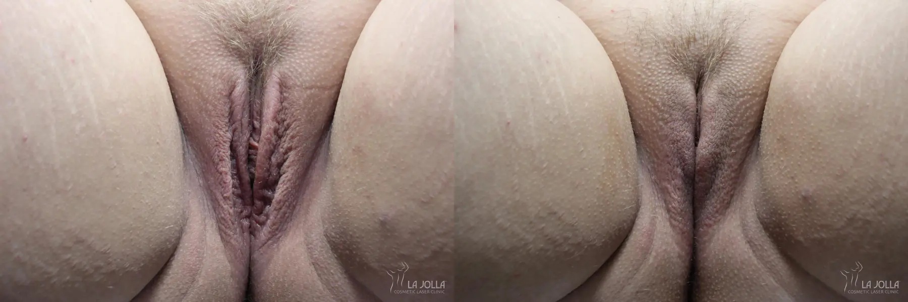 ThermiVa®: Patient 2 - Before and After  