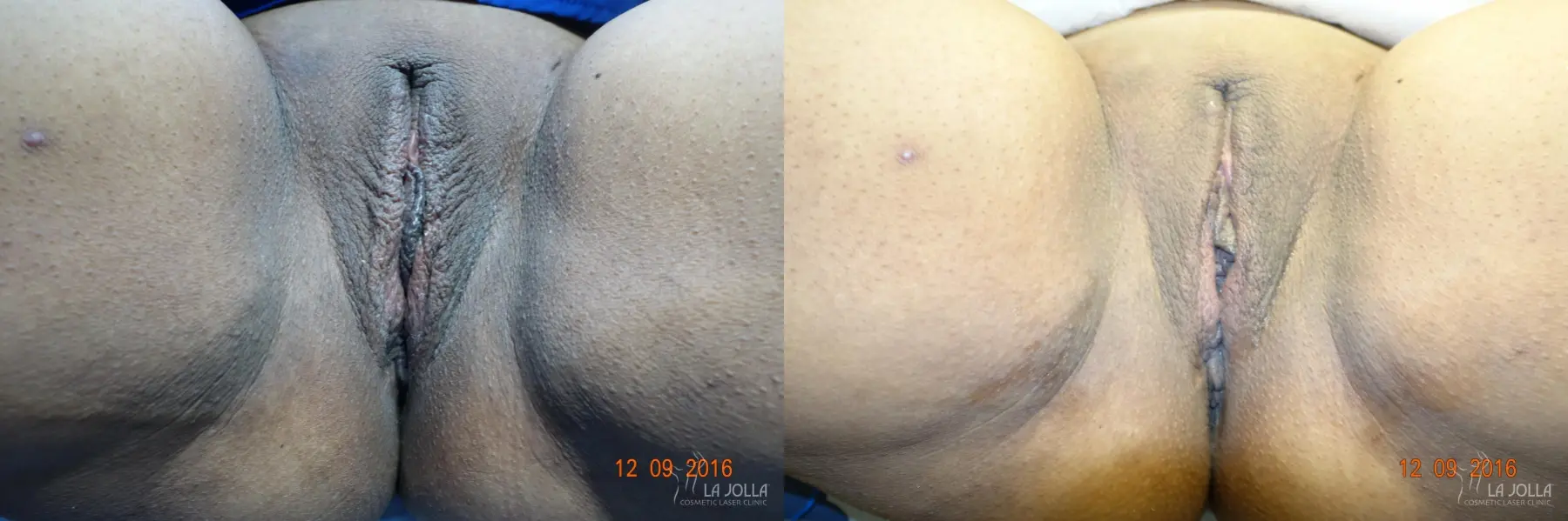 ThermiVa®: Patient 5 - Before and After 1