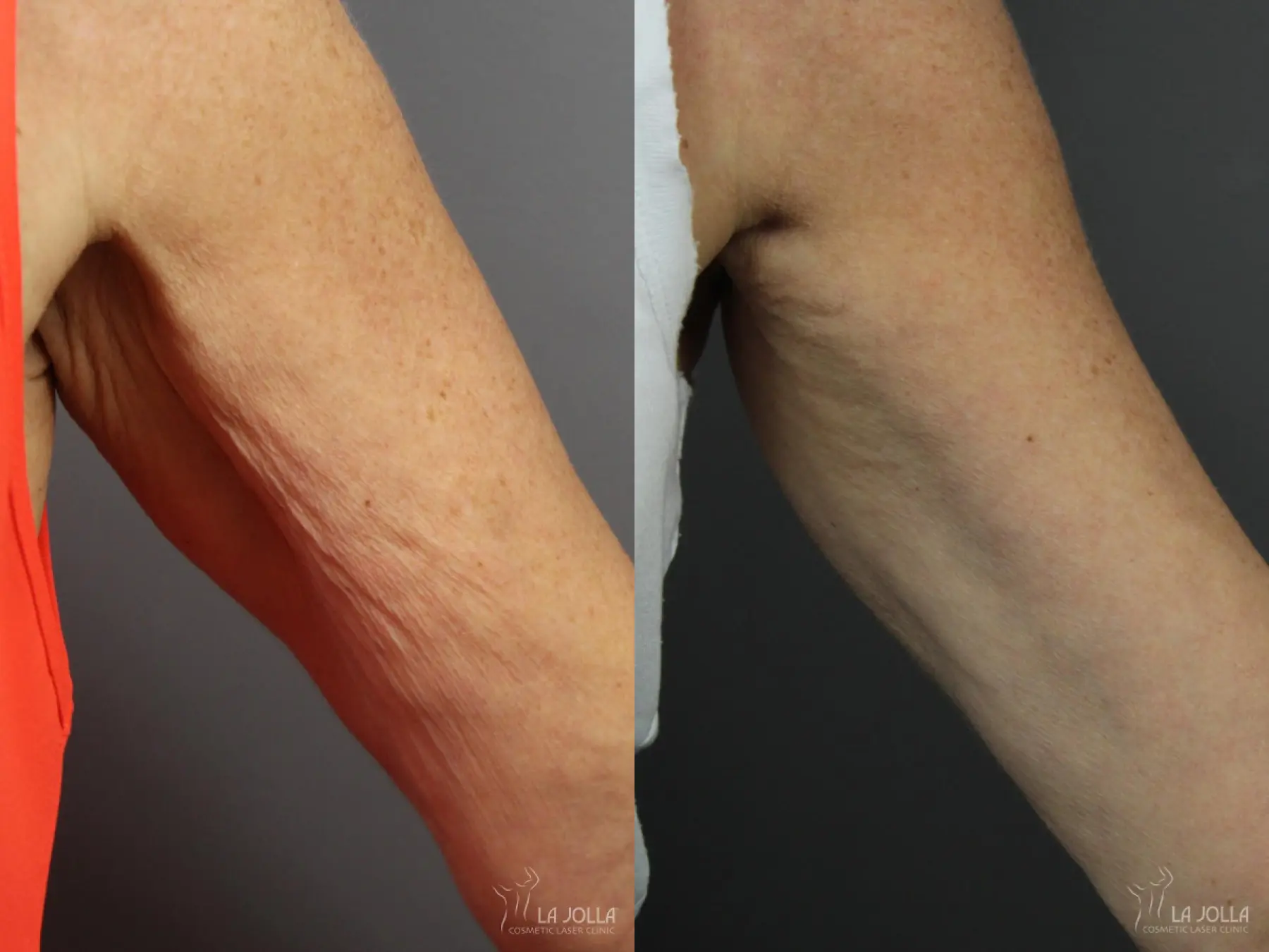 TightSculpting: Patient 1 - Before and After 2