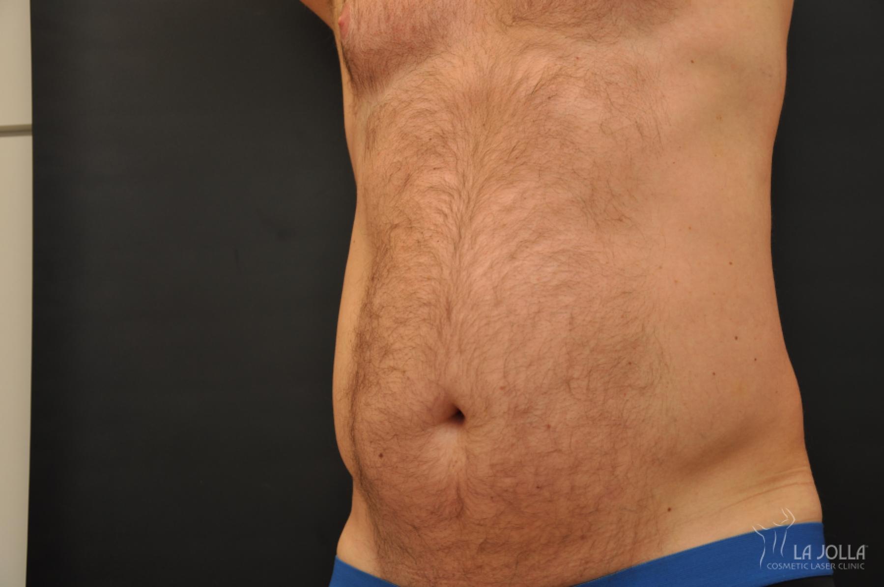 CoolSculpting®: Patient 11 - After 1