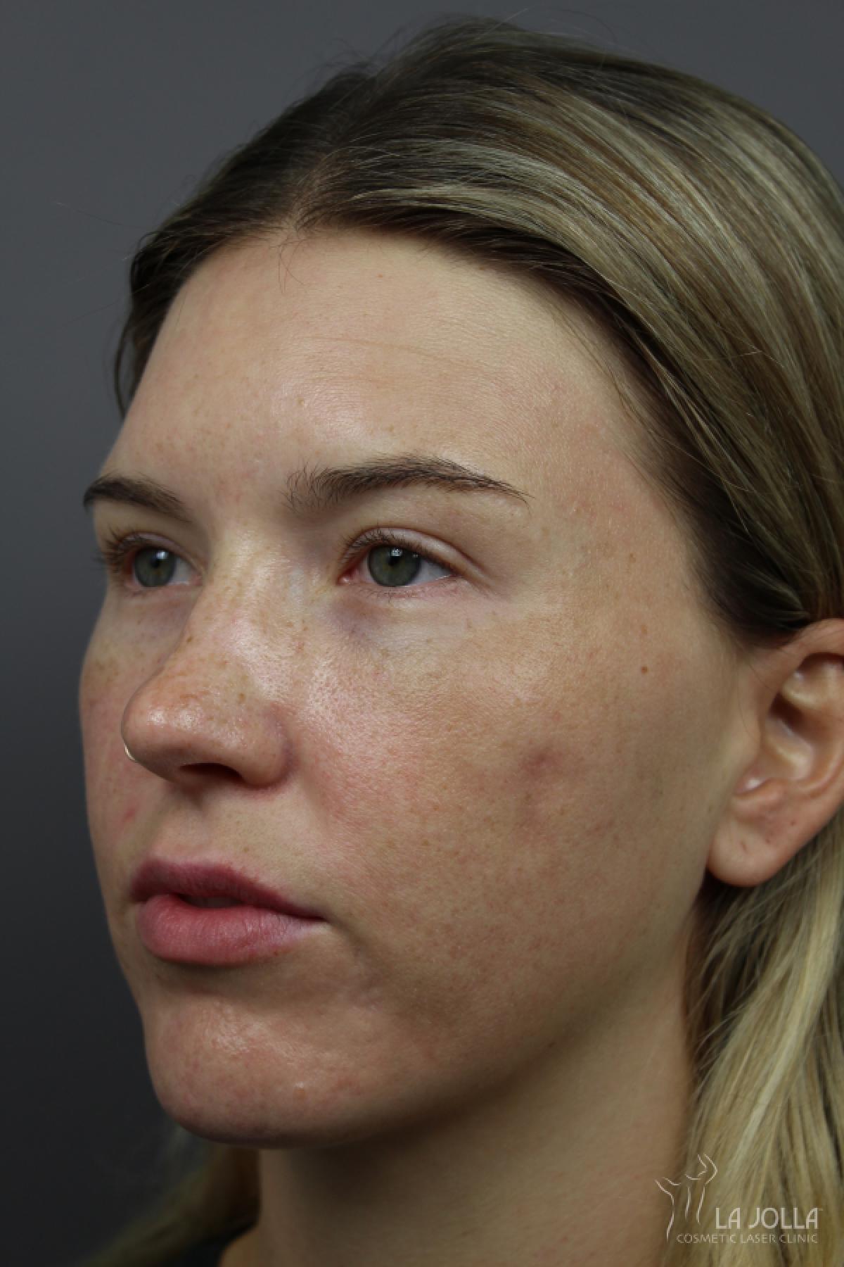 StarWalker® Laser: Patient 11 - After 1