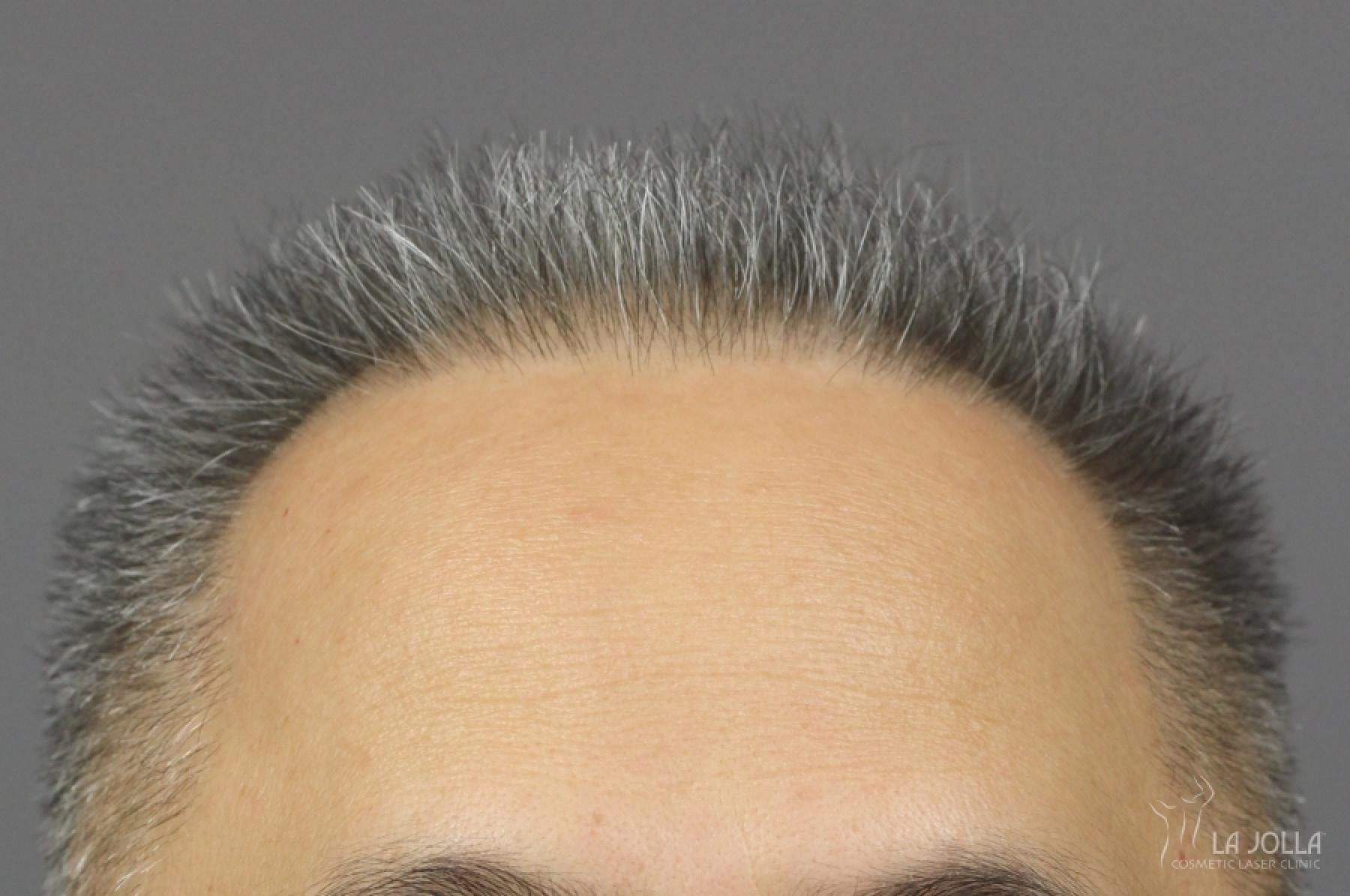 Hair Restoration: Patient 2 - Before 2