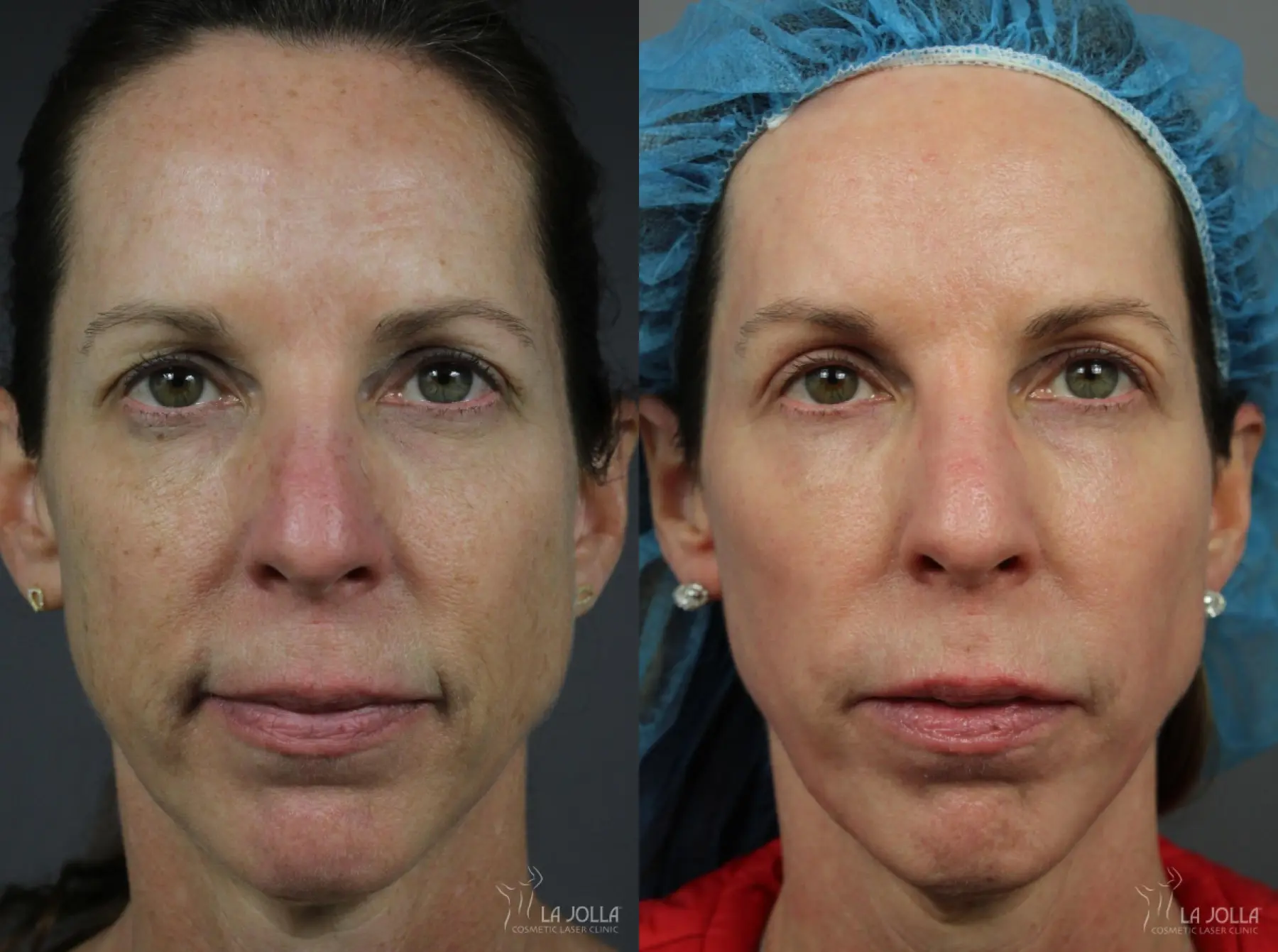 Ultherapy®: Patient 6 - Before and After  