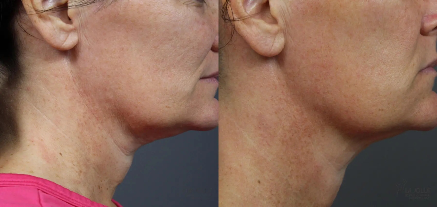 Ultherapy®: Patient 1 - Before and After  