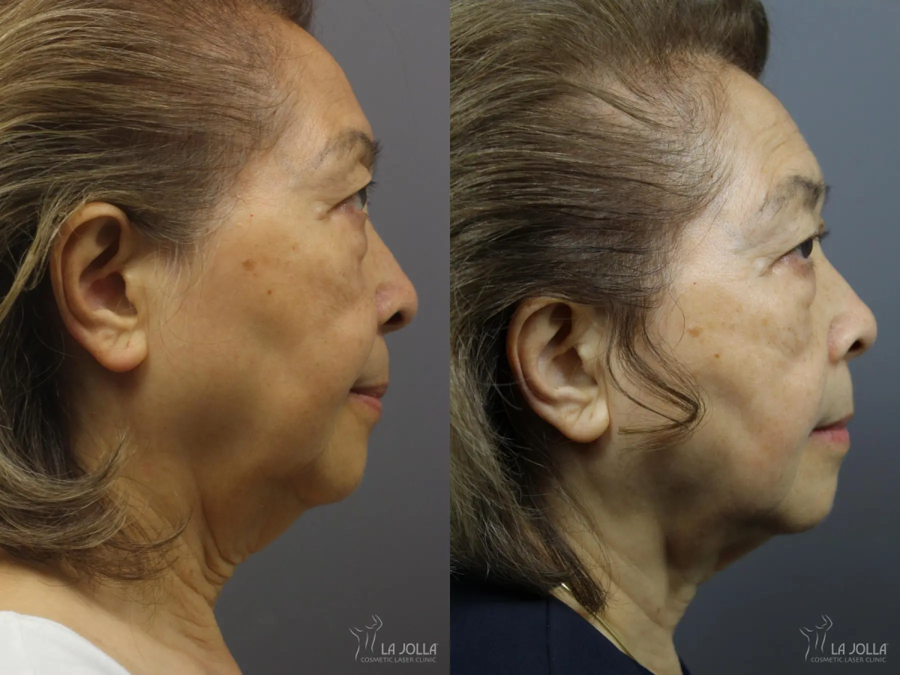 Ultherapy®: Patient 3 - Before and After  