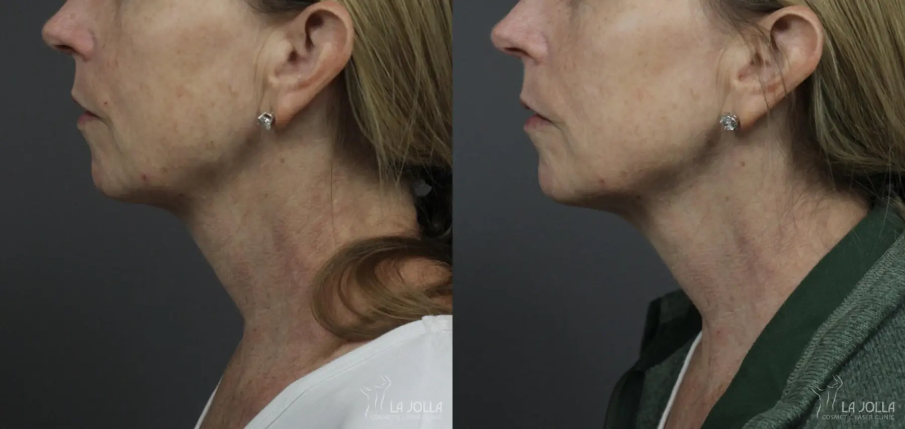 Ultherapy®: Patient 1 - Before and After 1
