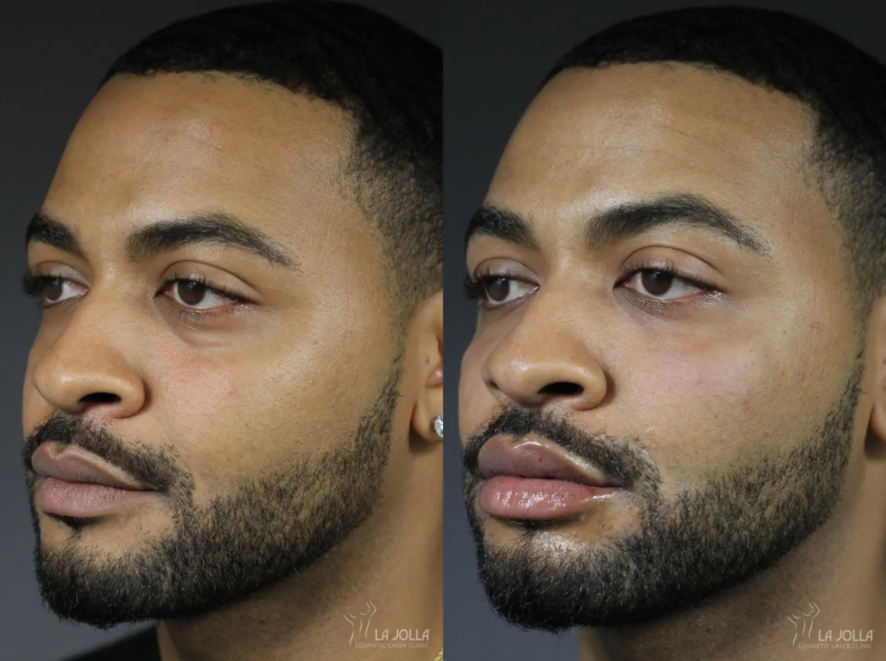 Under Eye Filler: Patient 7 - Before and After 1