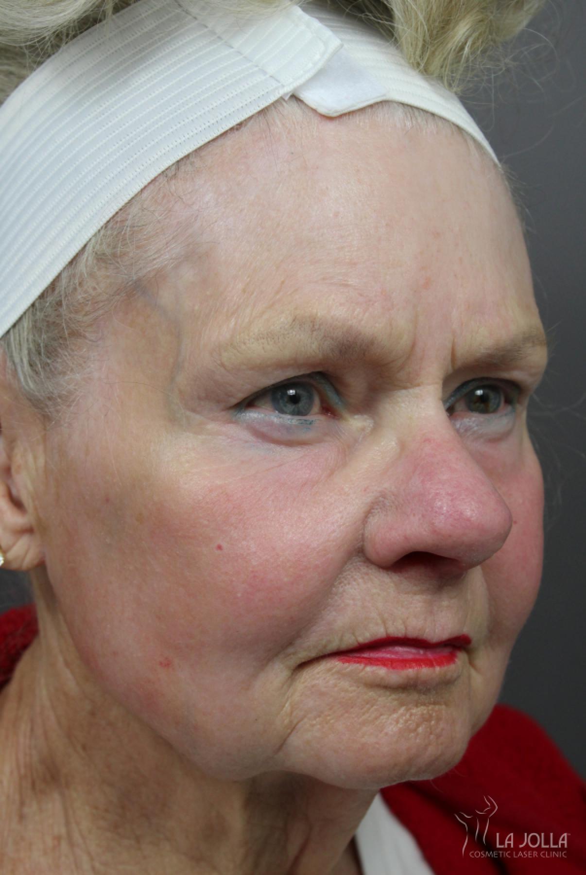 CO2 Laser: Patient 12 - After 2