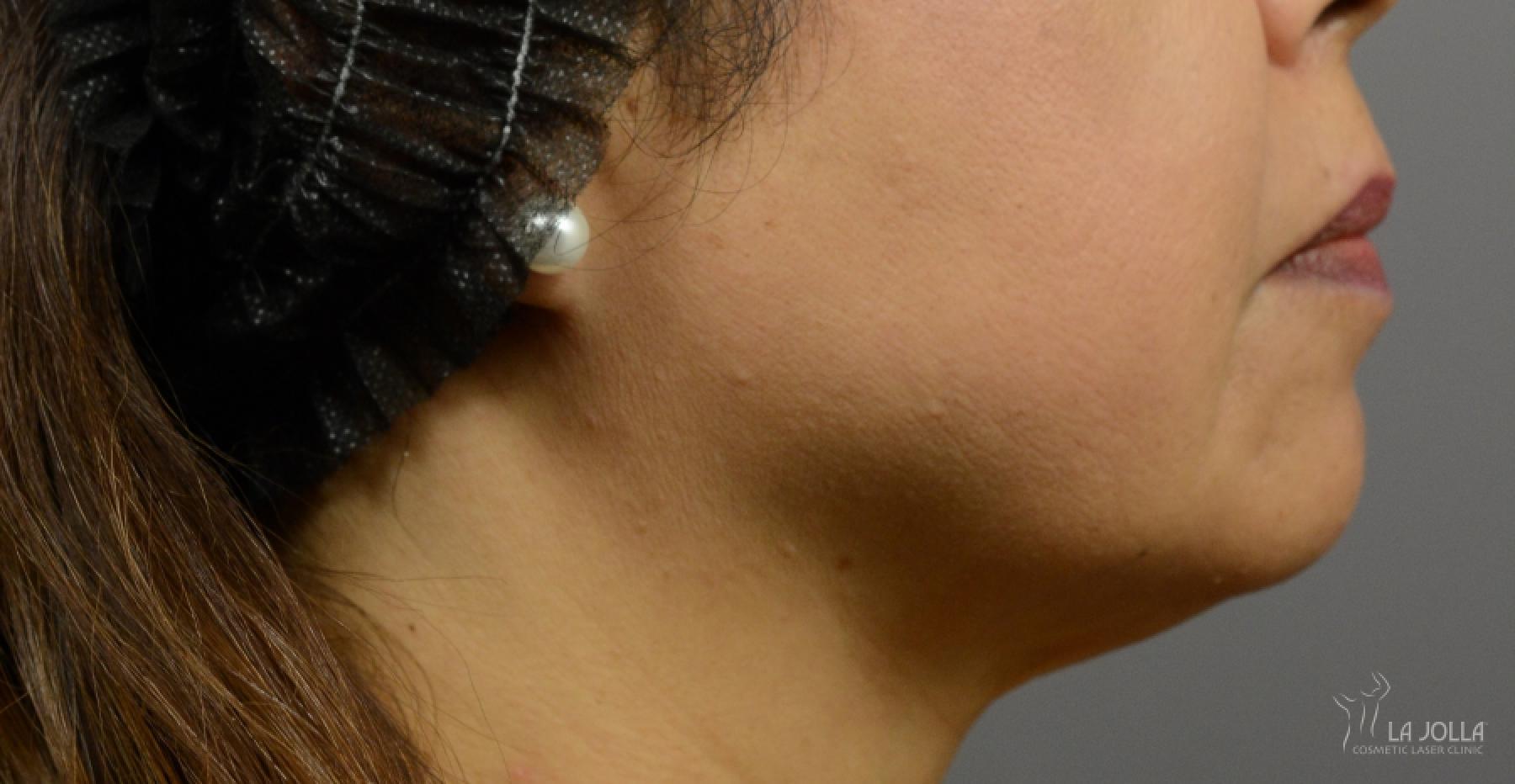 Kybella: Patient 3 - After 1
