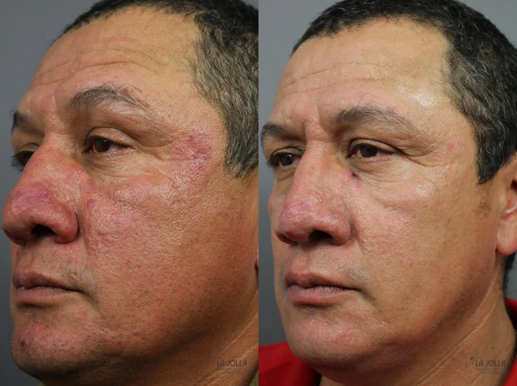 VBeam: Patient 3 - Before and After  