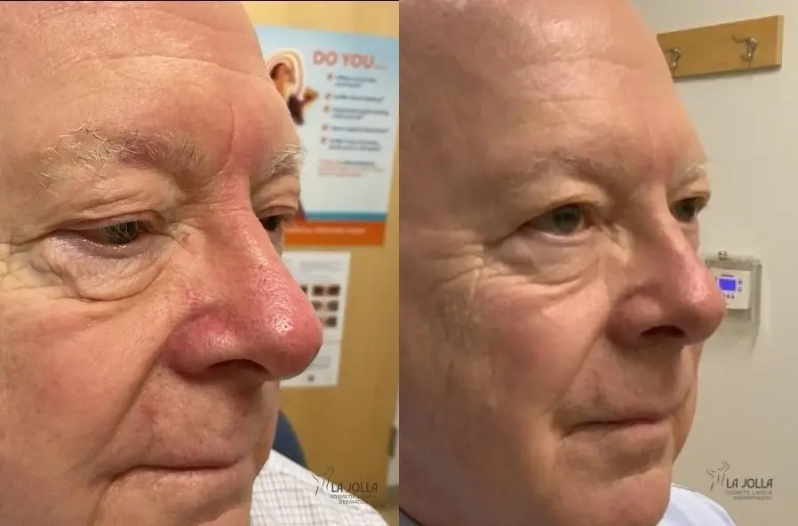 VBeam: Patient 5 - Before and After  