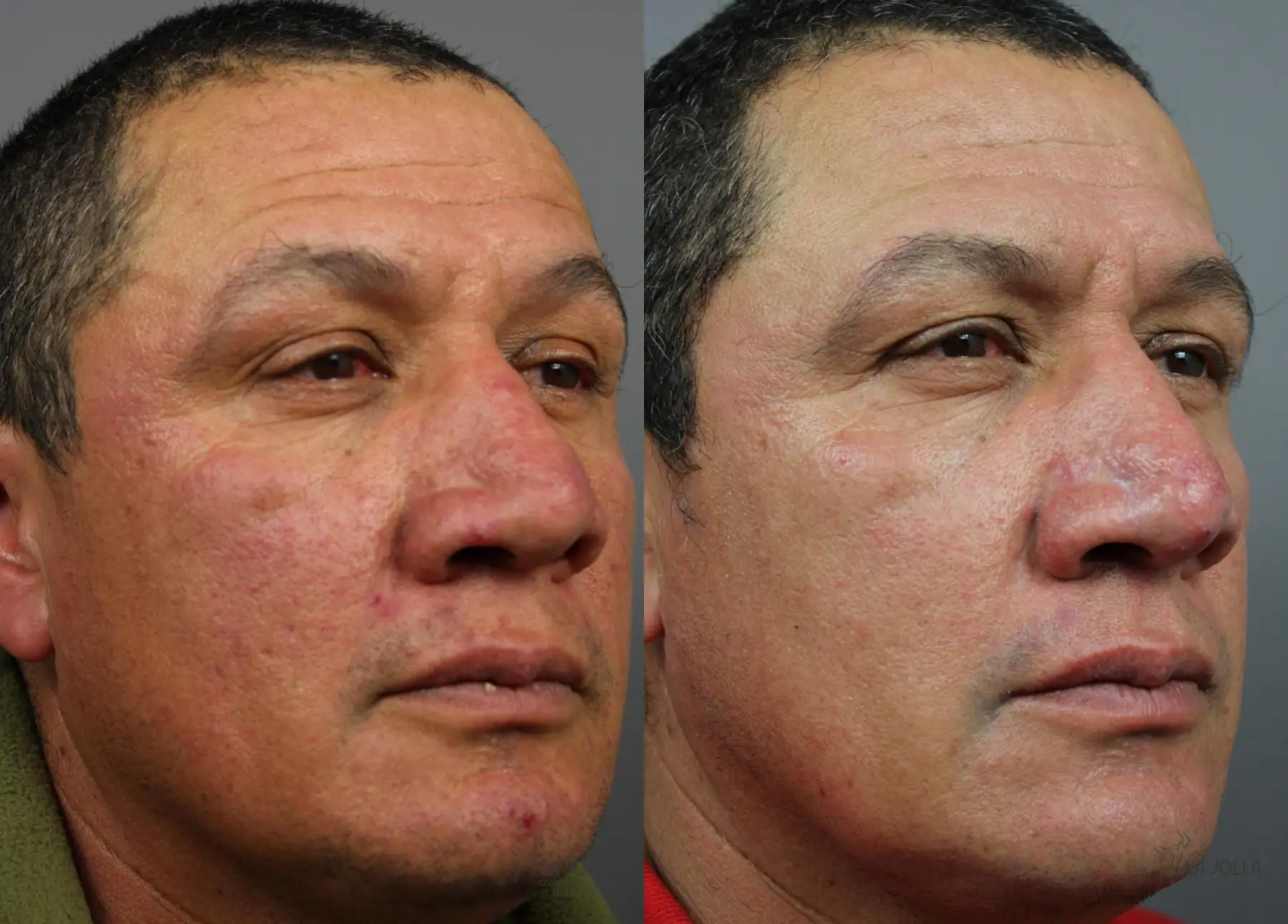 VBeam: Patient 2 - Before and After 2