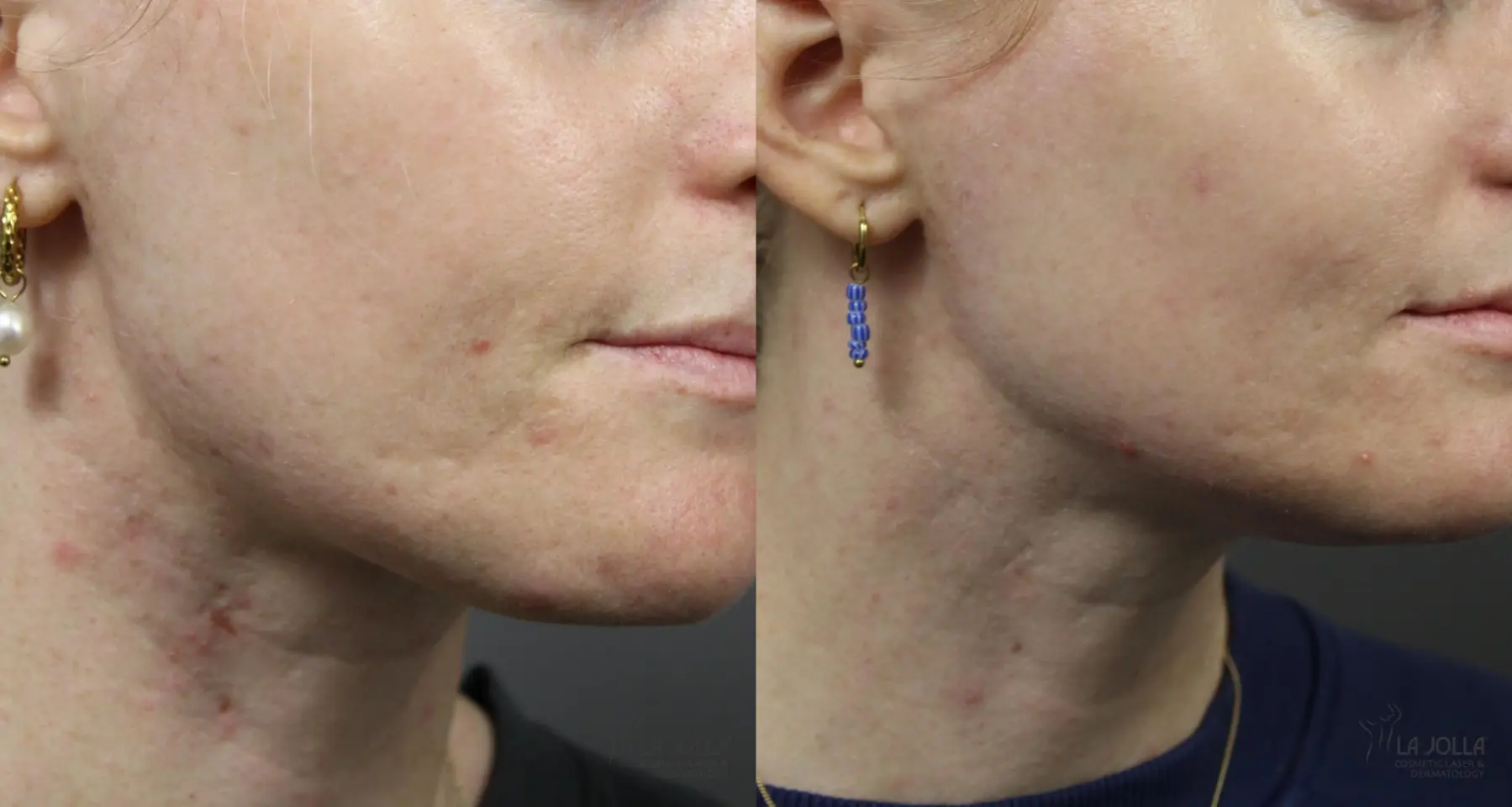 VBeam: Patient 1 - Before and After  