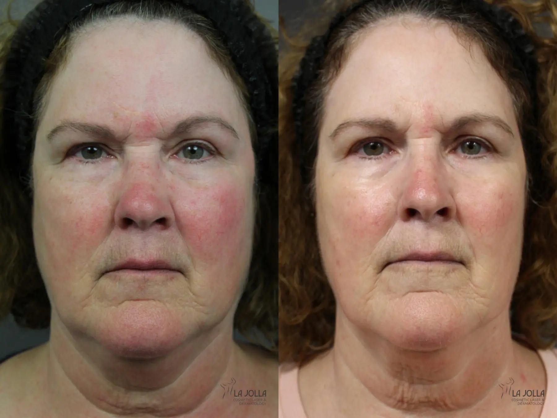 VBeam: Patient 2 - Before and After  