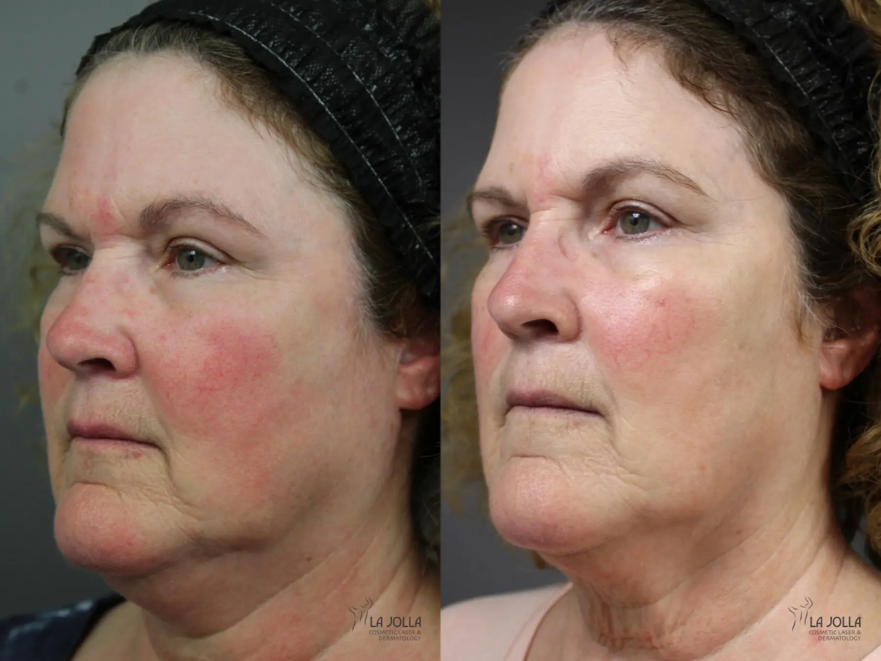 VBeam: Patient 2 - Before and After 3