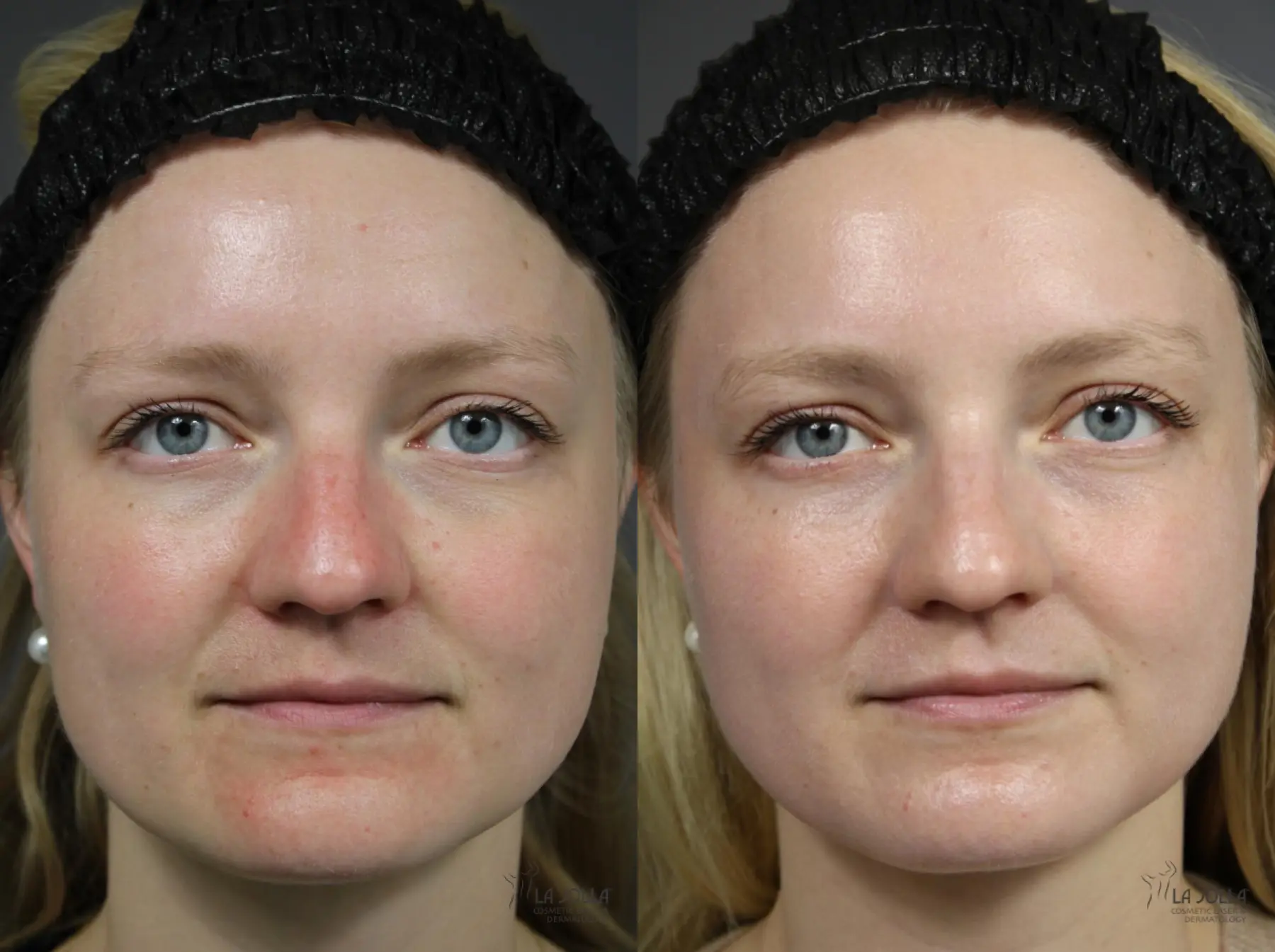 VBeam: Patient 1 - Before and After  