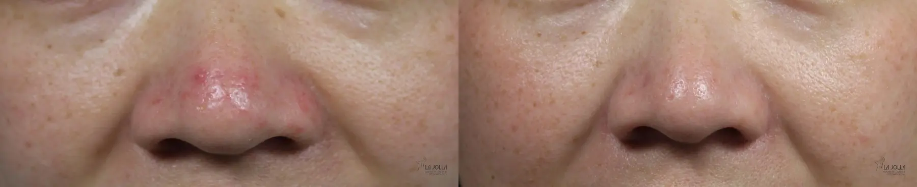 VBeam: Patient 1 - Before and After  