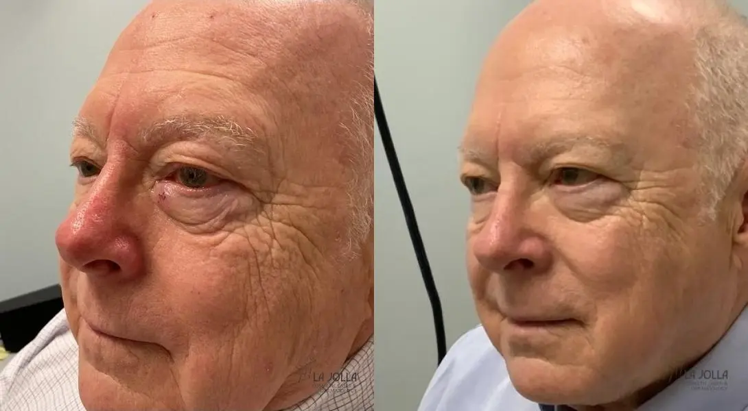 VBeam: Patient 5 - Before and After 2