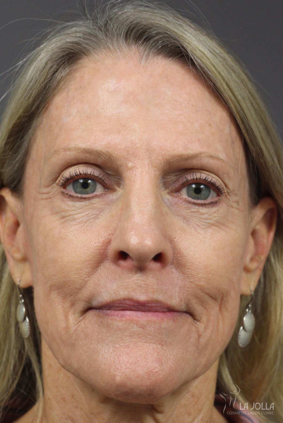 CO2 Laser: Patient 14 - After 1