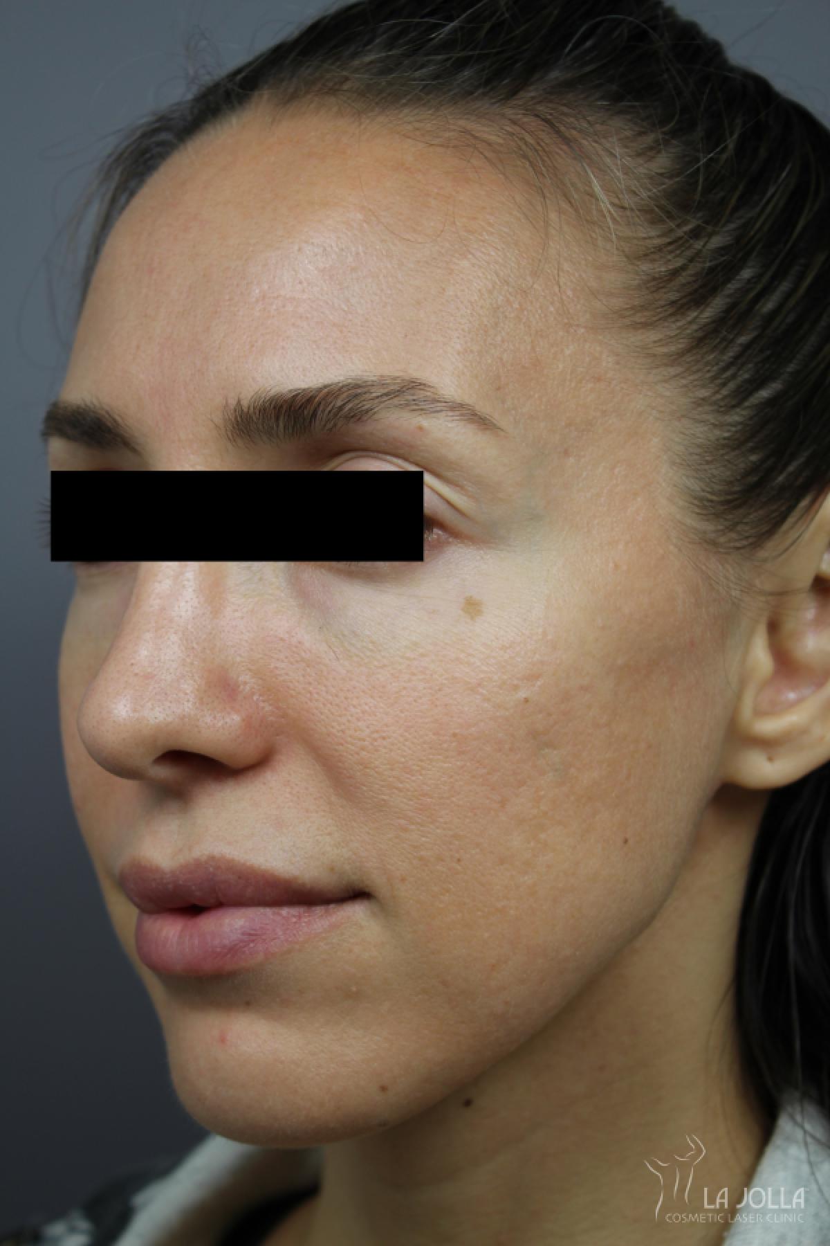 Under Eye Filler: Patient 1 - After 1