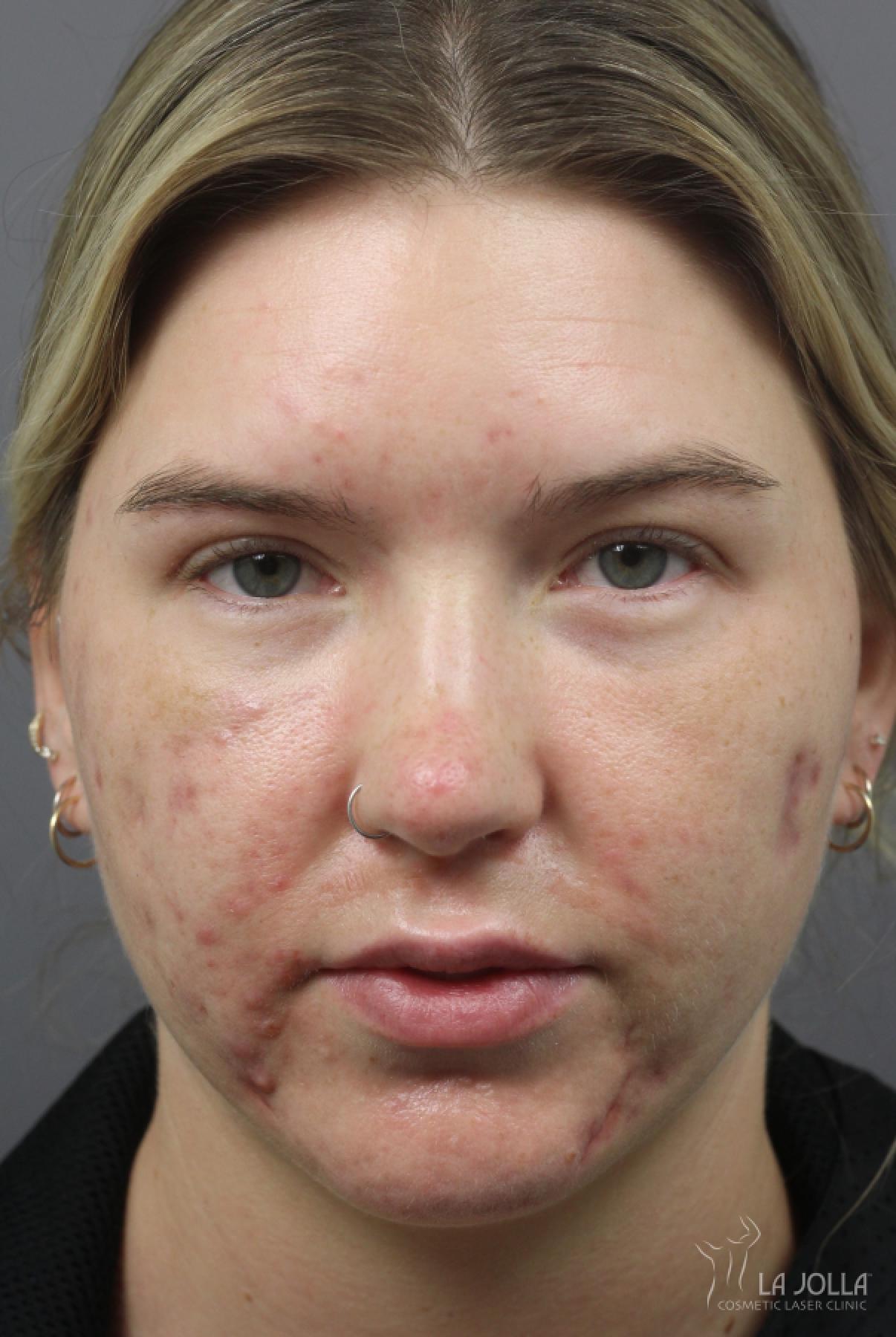 Acne Scars: Patient 2 - Before 2