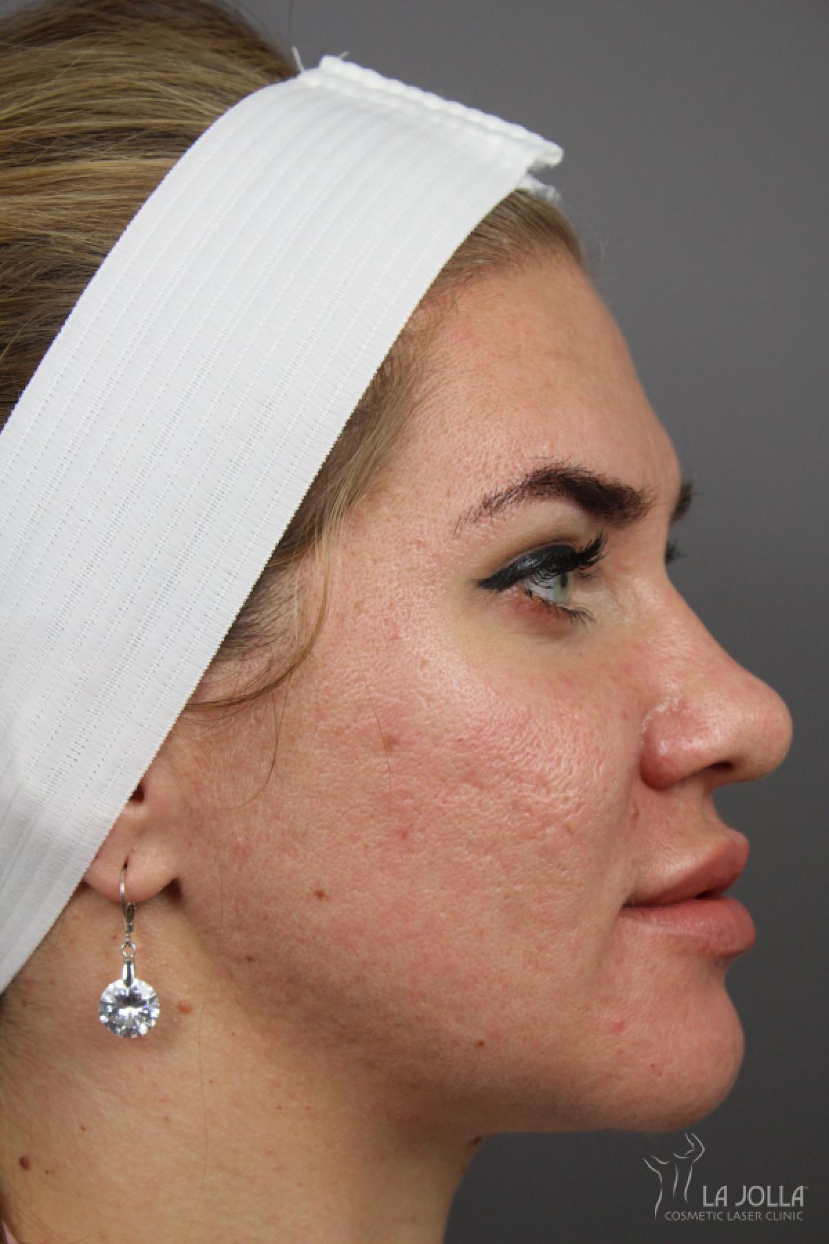 Acne Scars: Patient 8 - After 1