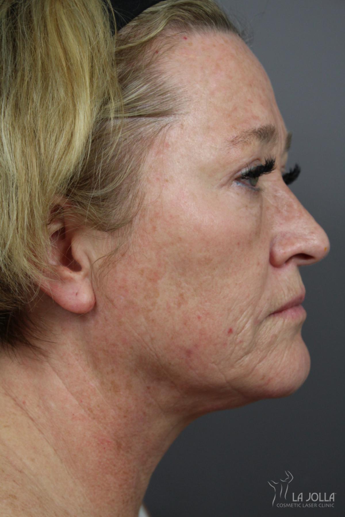 CO2 Laser: Patient 22 - Before and After 3