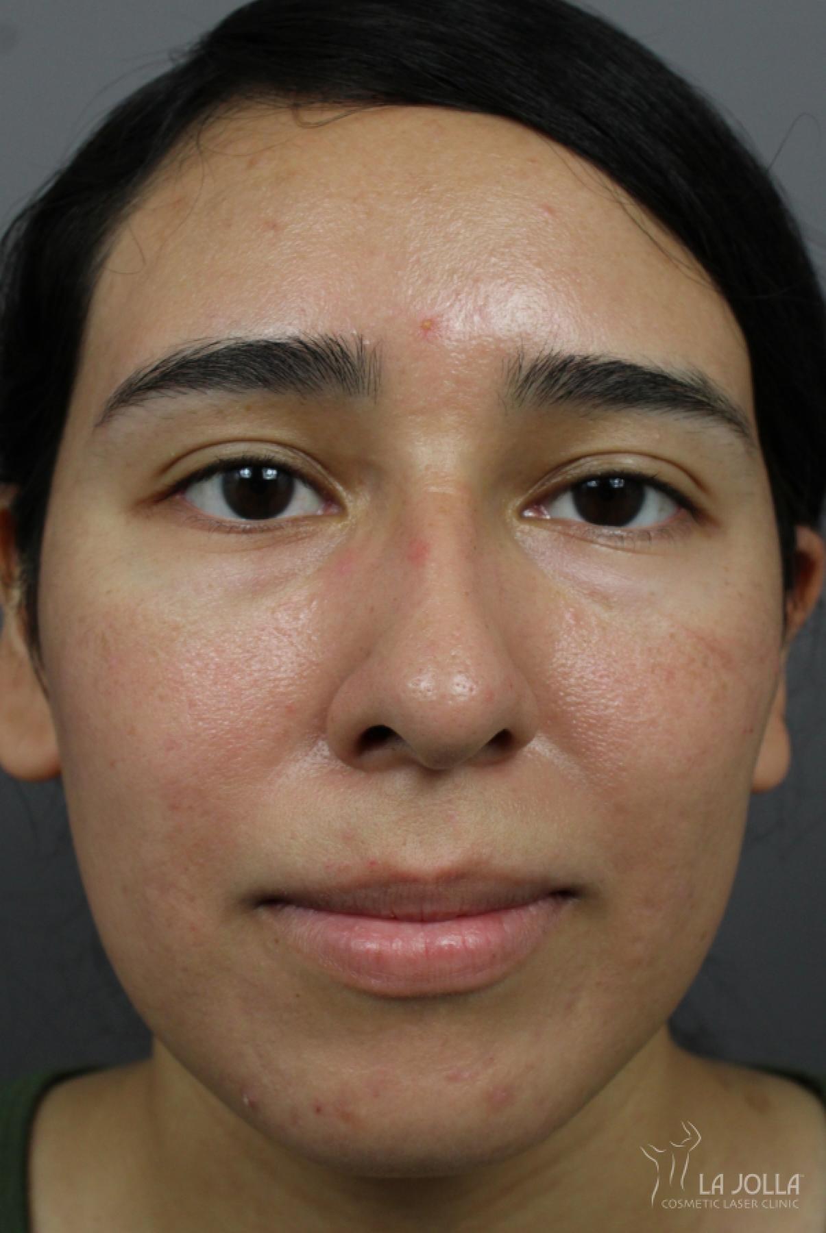 Acne Rejuvenation: Patient 5 - After  