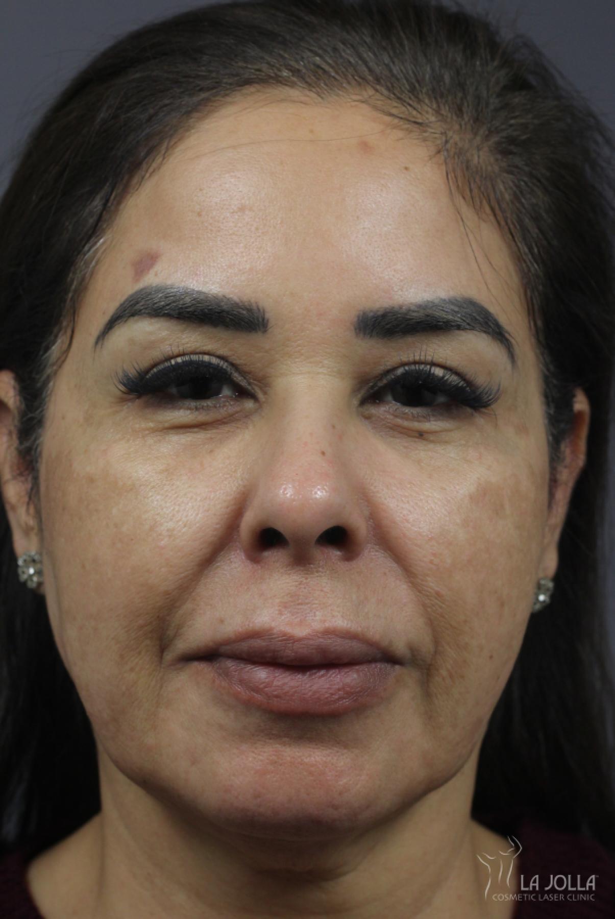 Chemical Peel: Patient 3 - Before 1