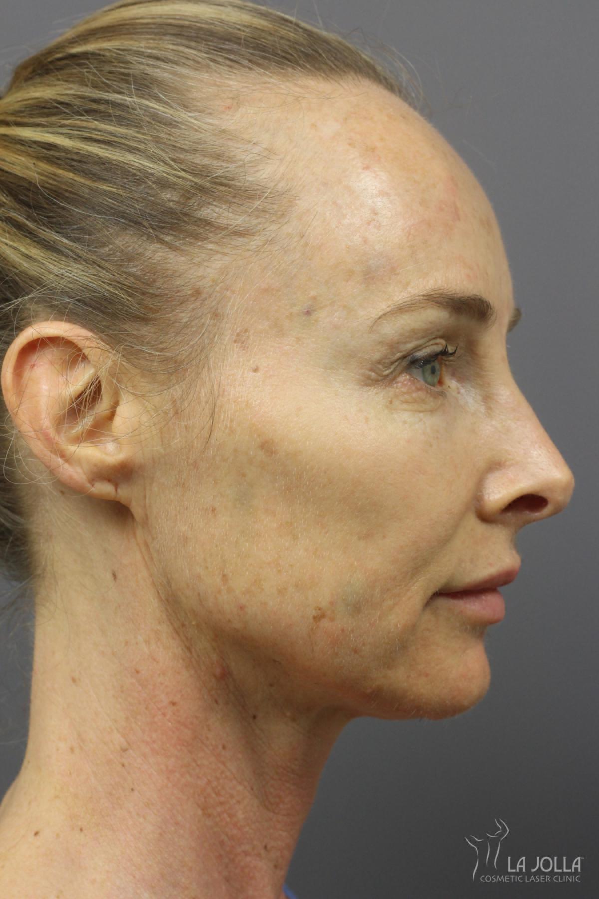 CO2 Laser: Patient 21 - Before and After 2