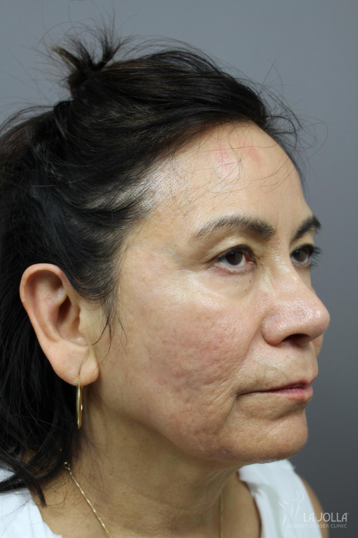 StarWalker® Laser: Patient 13 - After 1