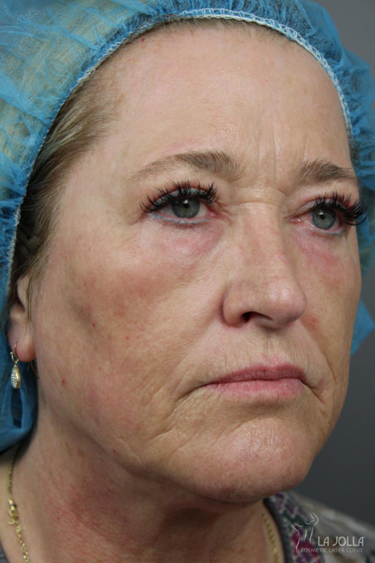 CO2 Laser: Patient 22 - After 2