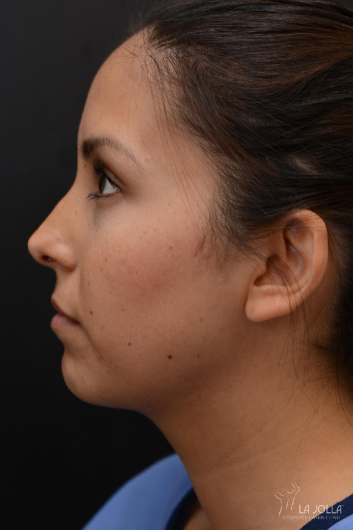 Kybella: Patient 5 - After  