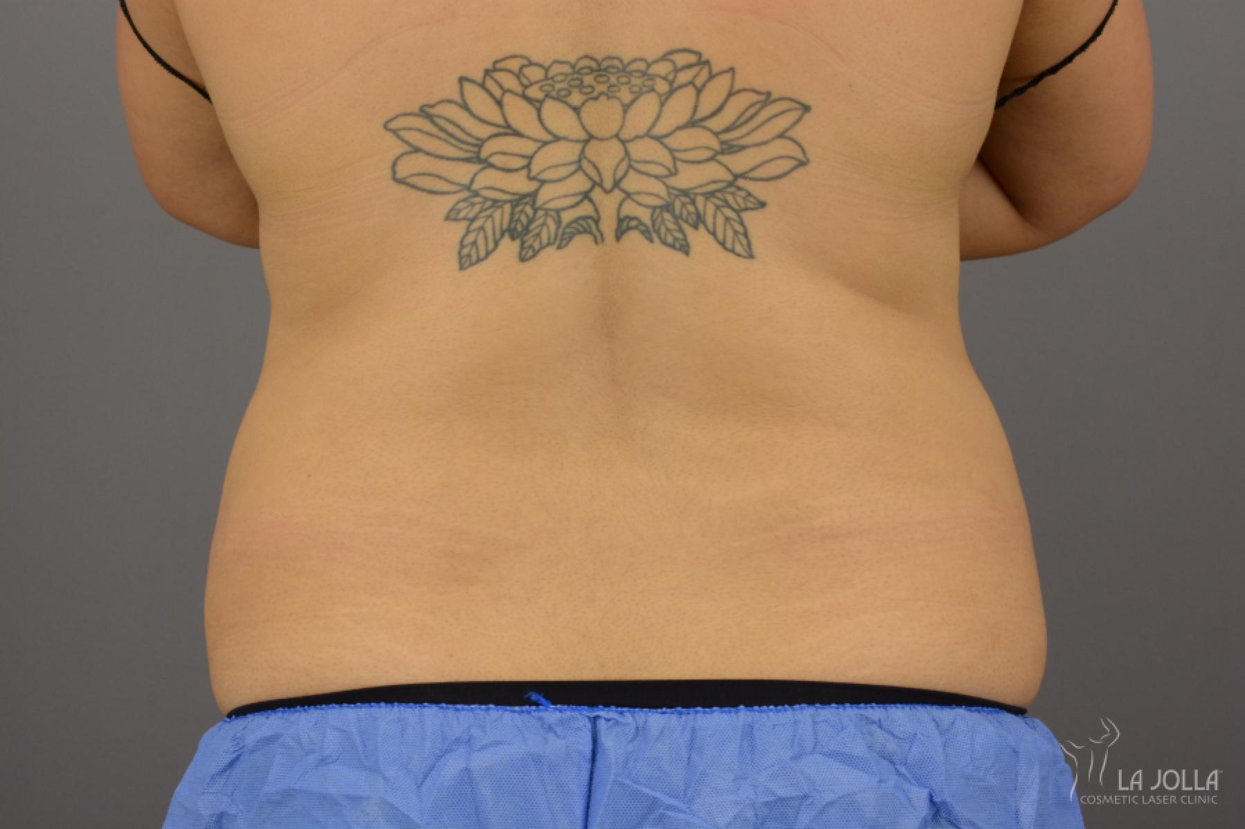 CoolSculpting®: Patient 14 - After 1