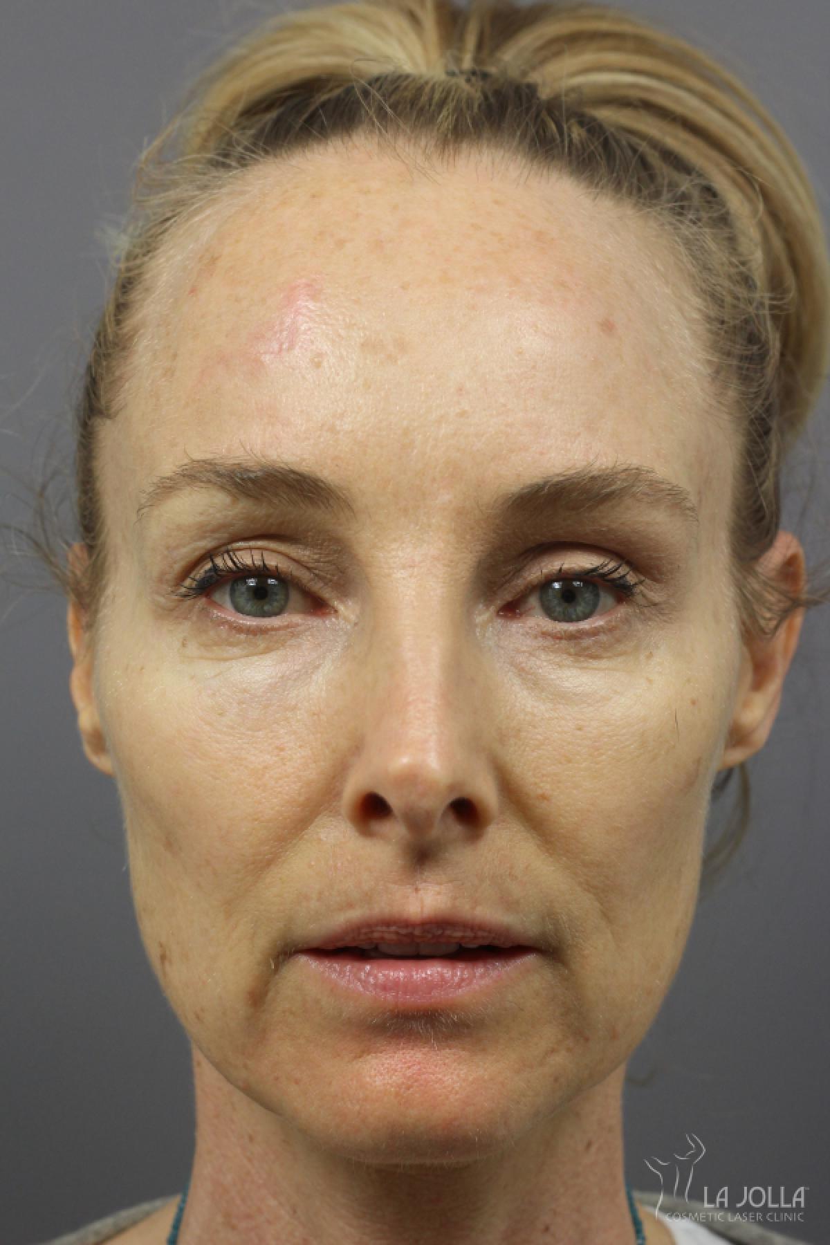 CO2 Laser: Patient 21 - Before 1