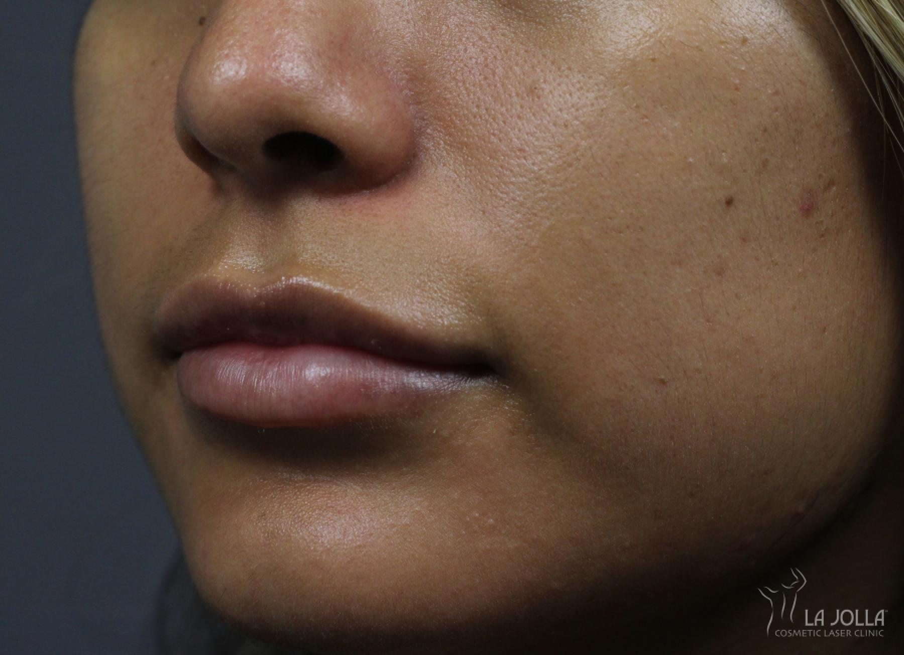 Lip Filler: Patient 12 - After 3