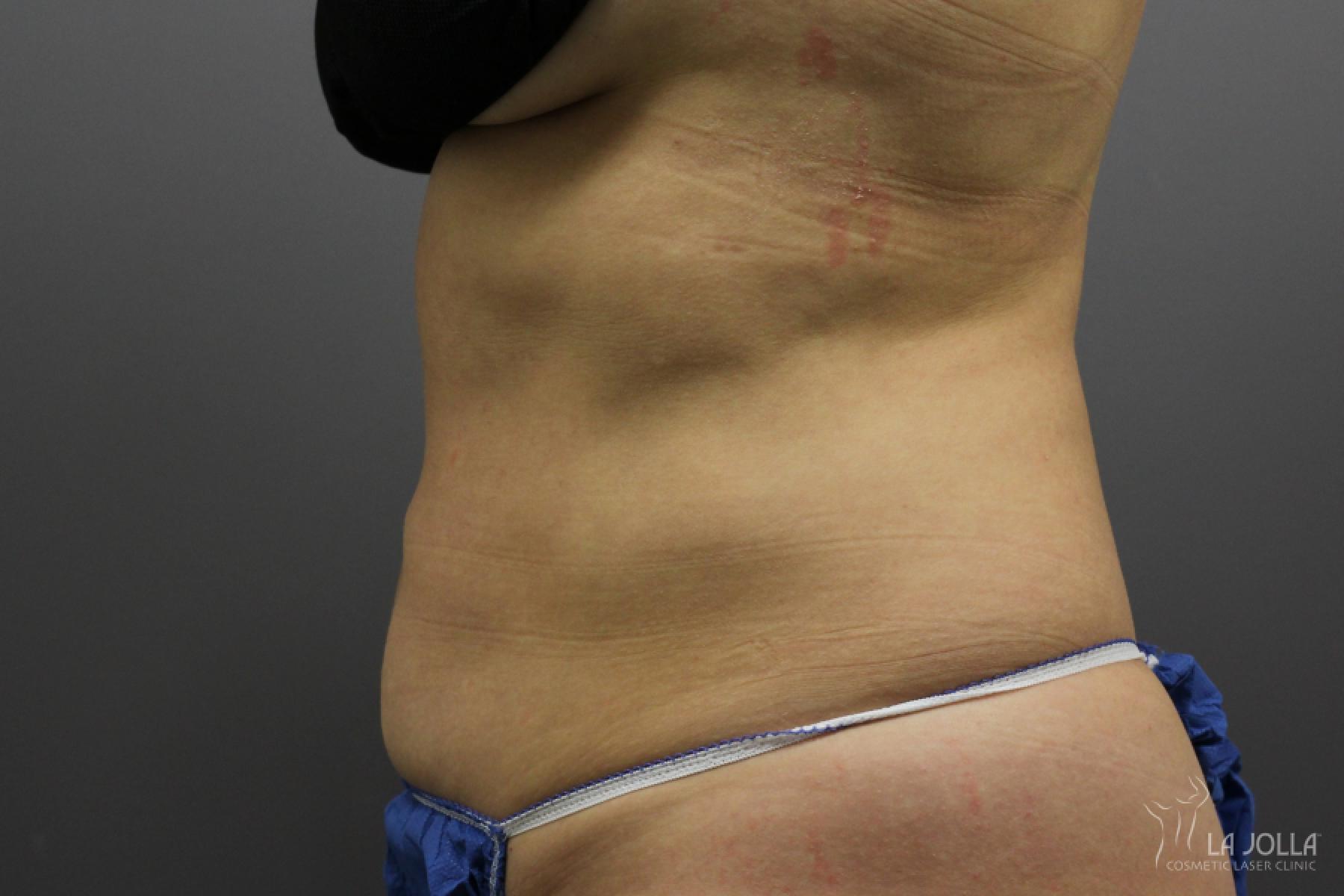 CoolSculpting®: Patient 6 - After 2