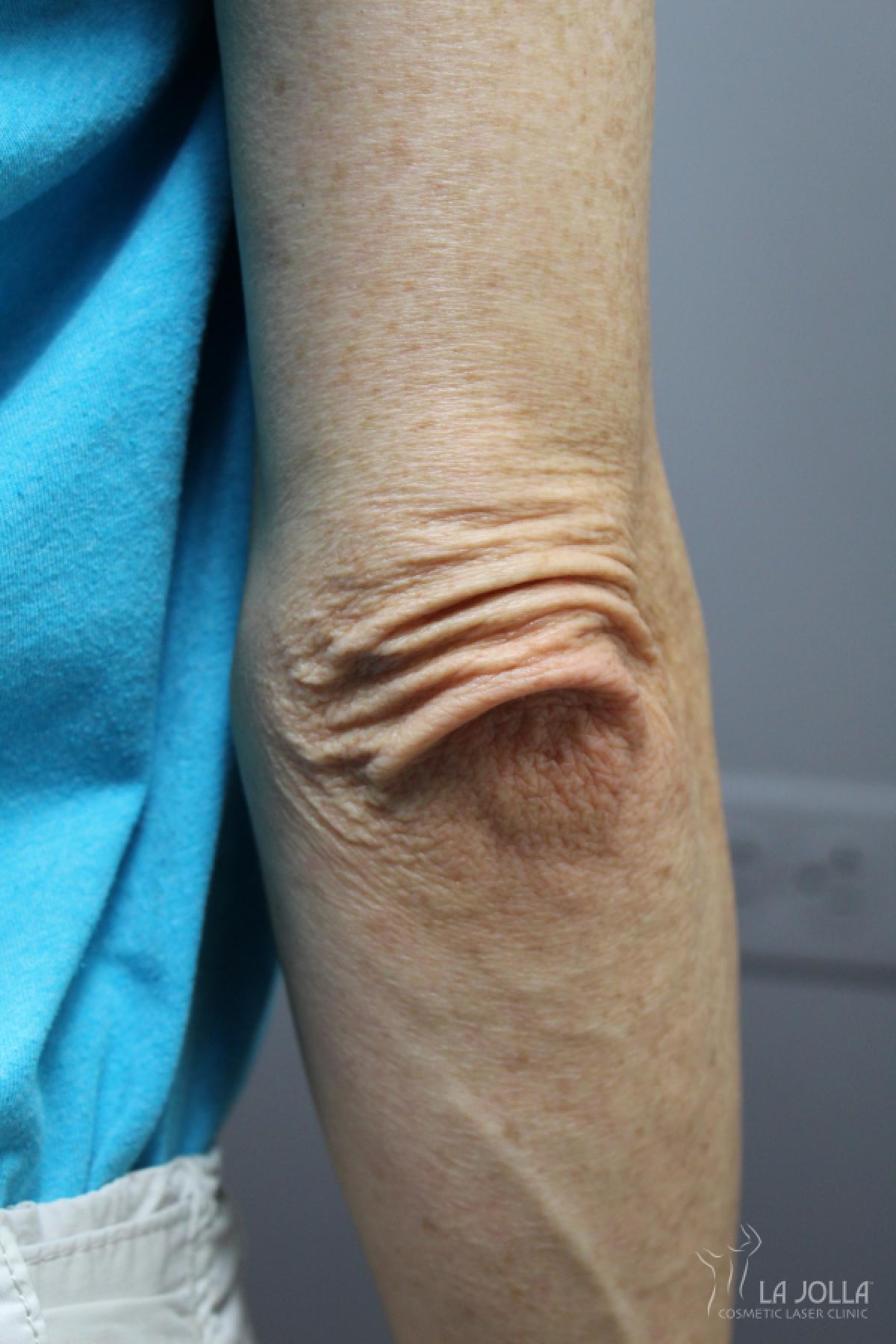 StarWalker® Laser: Patient 8 - Before 1