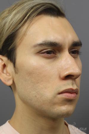 Acne Scars: Patient 7 - After  