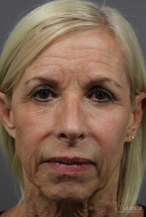 Sculptra®: Patient 8 - Before 