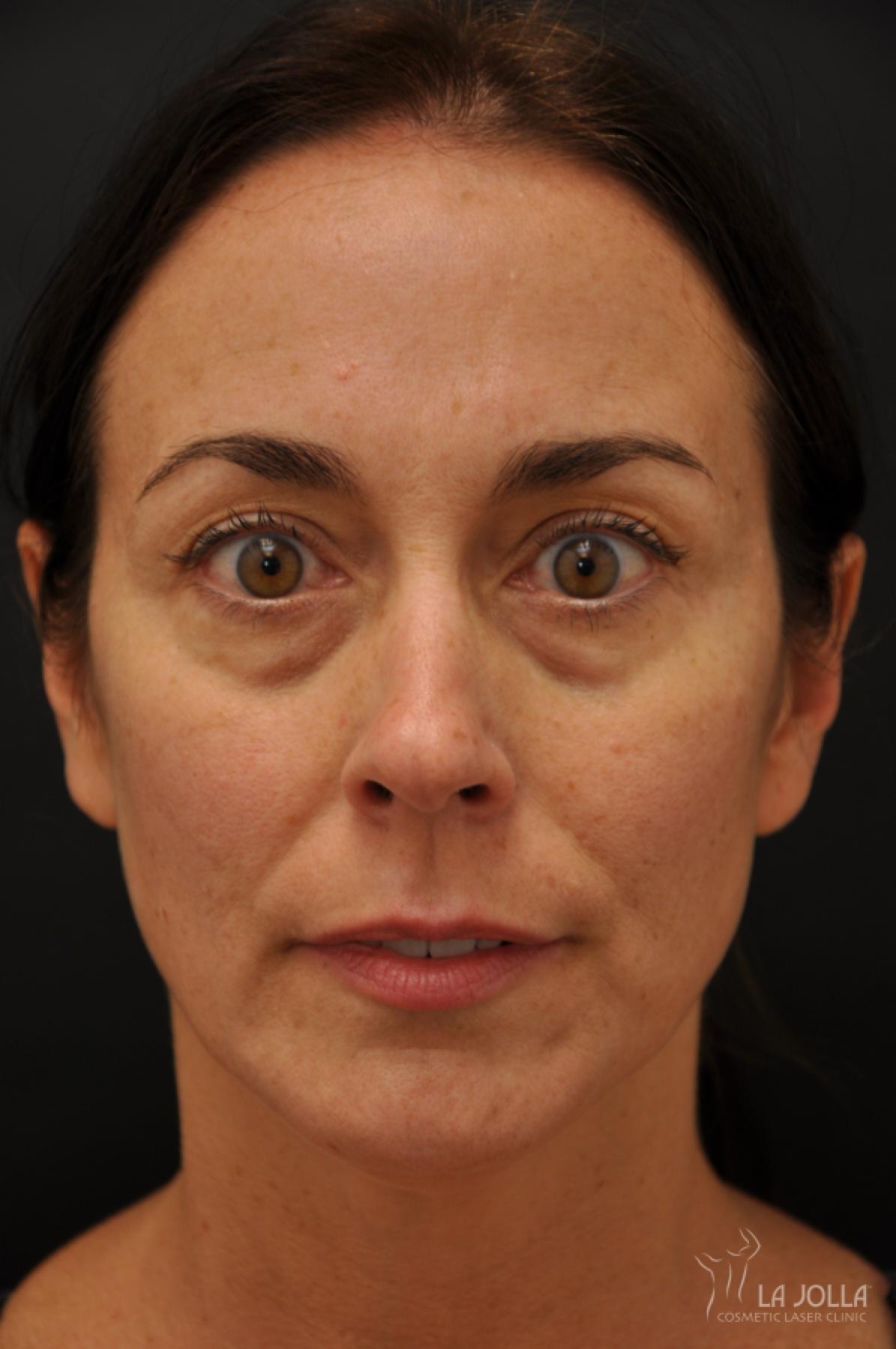 Under Eye Filler: Patient 5 - Before 