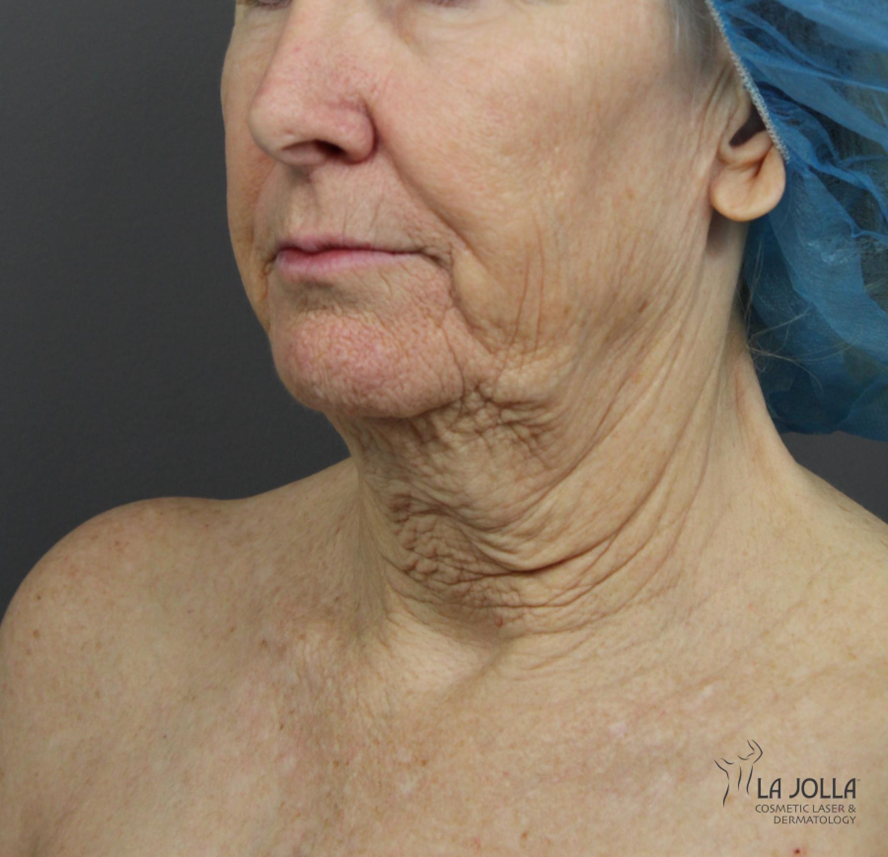 CO2 Laser: Patient 4 - Before 2